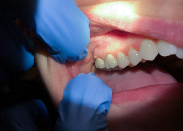 Best Emergency Treatment for Dental Infections or Abscesses in Ridgeland, SC